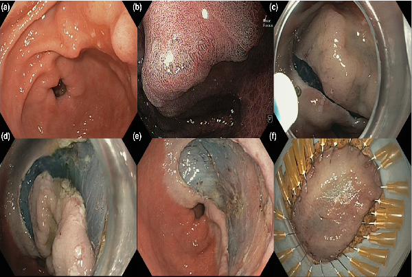 Endoscopic Submucosal Dissection