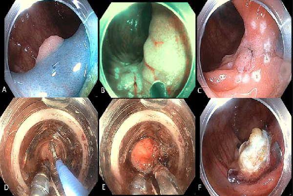 Endoscopic Full Thickness Resection